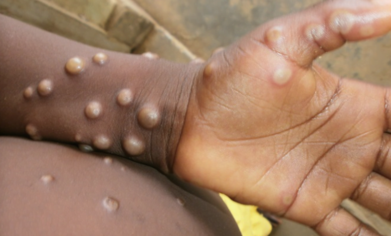 WHO Declares Mpox A Global Public Health Emergency