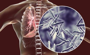 Tuberculosis Outbreak? The Ancient Disease Reappears