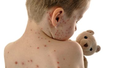 Measles Outbreak In South Carolina Measles Outbreak In South Carolina