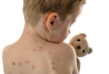 Utah Measles Outbreak Tops 700