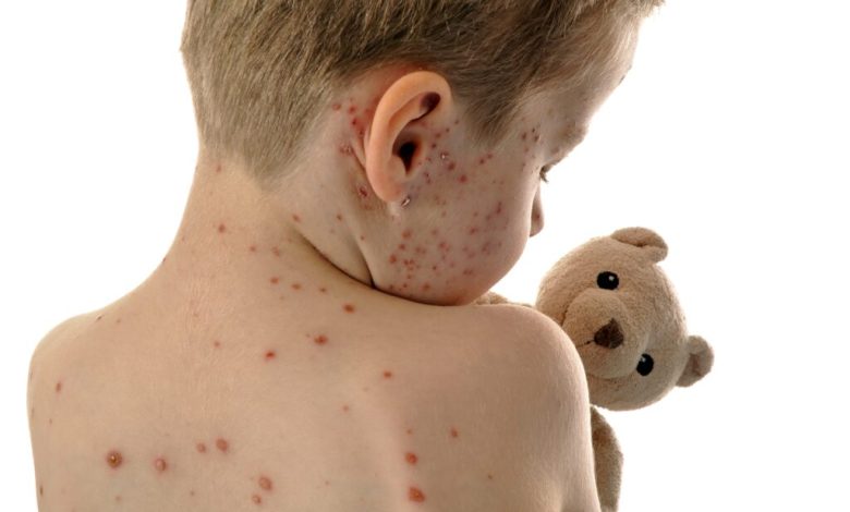 Utah Measles Outbreak Tops 700