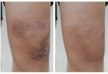 Old Style Bone And Bruise Care – From Arnica To Comfrey Poultices – Survivopedia