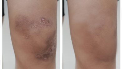 Old Style Bone And Bruise Care – From Arnica To Comfrey Poultices – Survivopedia