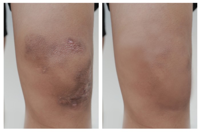 Old Style Bone And Bruise Care – From Arnica To Comfrey Poultices – Survivopedia